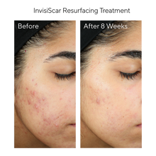 Load image into Gallery viewer, Murad Acne Control 30-Day Trial Kit
